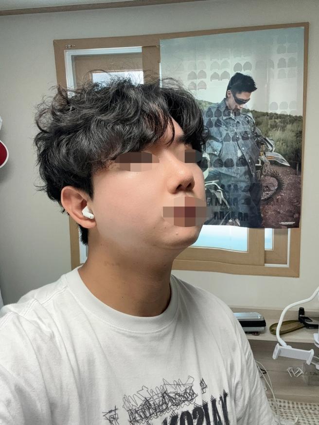 男性隆鼻术