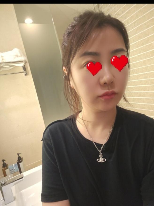 리쥬란 3회 완료 후기 – 잔주름에 톤까지, 재방문 확정입니다