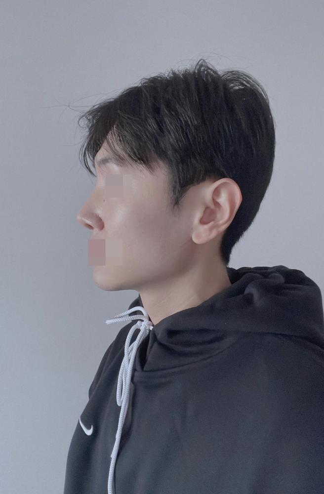 男性隆鼻術