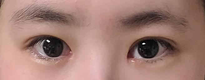 눈매교정&안검하수