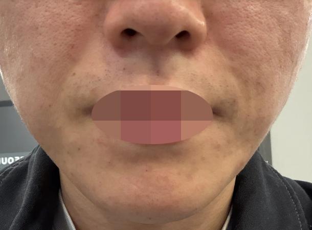 리쥬베룩 수면마취로 받으니 생각보다 훨씬 편했습니다~