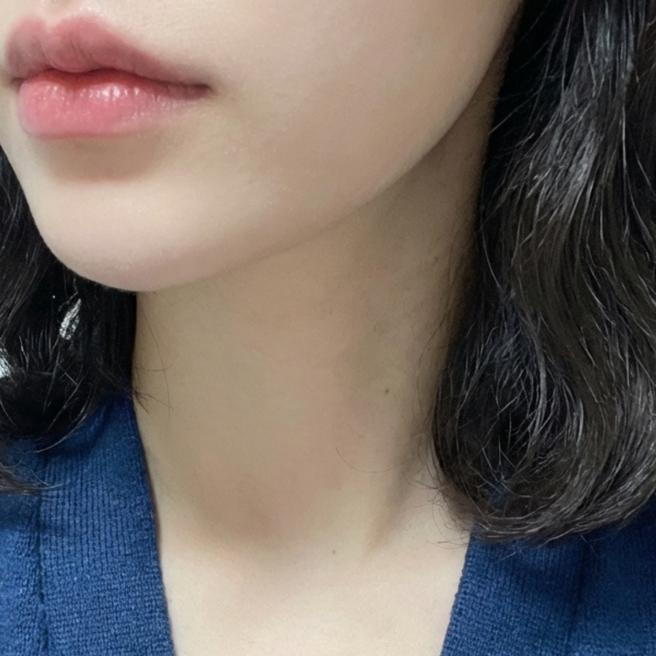 슈링크 1주차 경과, 턱선 정리되는 중이에요