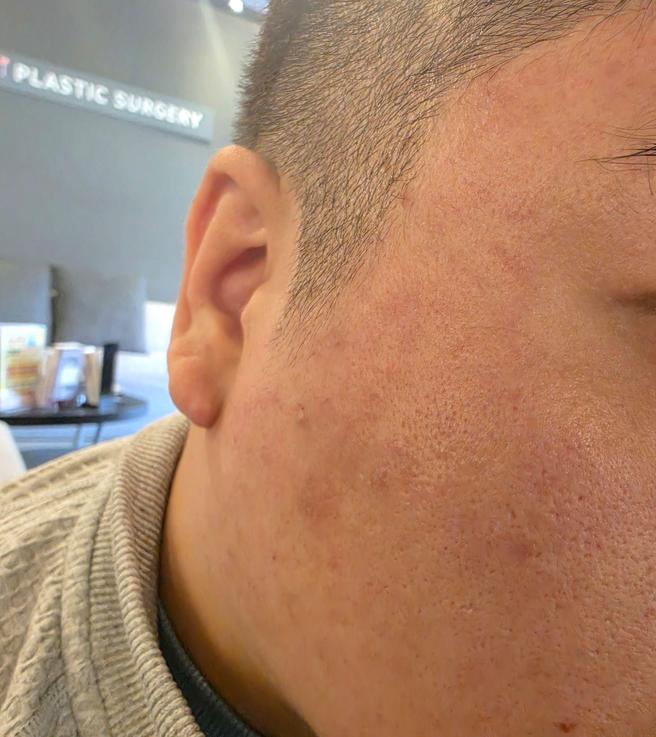 친절한 응대에 시술까지 만족, 남자도 부담 없이 받고 왔어요.