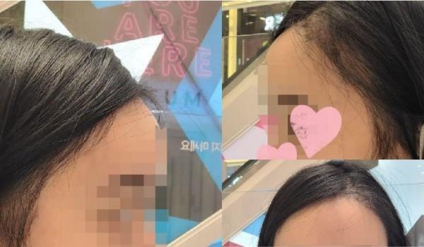 Seoul i Hair Transplant