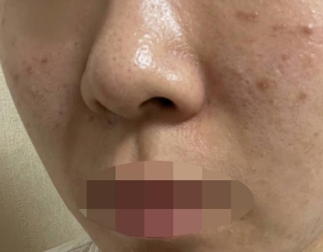 리쥬란 4cc 수면마취로 편하게 받았는데 결과까지 만족스러워요~