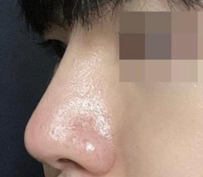 自体肋软骨鼻翻修手术