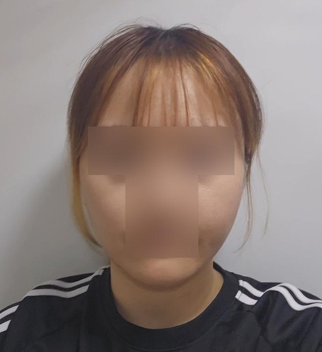 ดูดไขมันใบหน้า