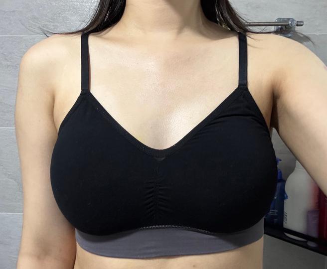 Stem Cell Chest Fat Grafting