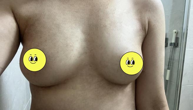 PRP Breast Fat Grafting