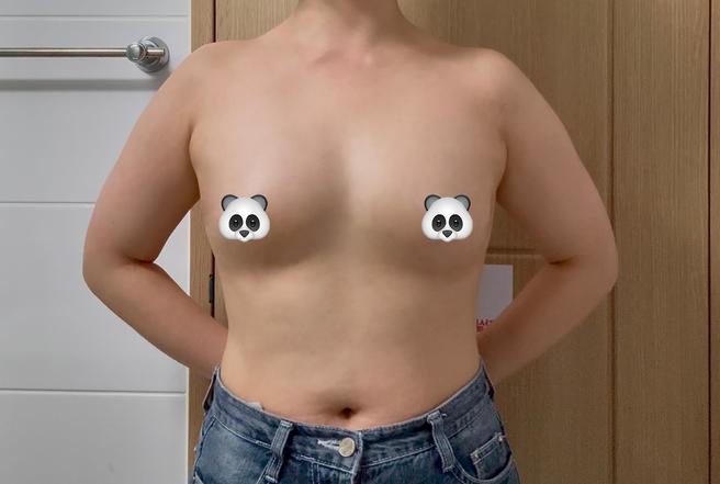 Stem Cell Chest Fat Grafting