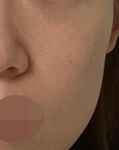 속건조랑 눈가 잔주름 때문에 받았는데 친절해서 좋았어요 ㅎㅎ
