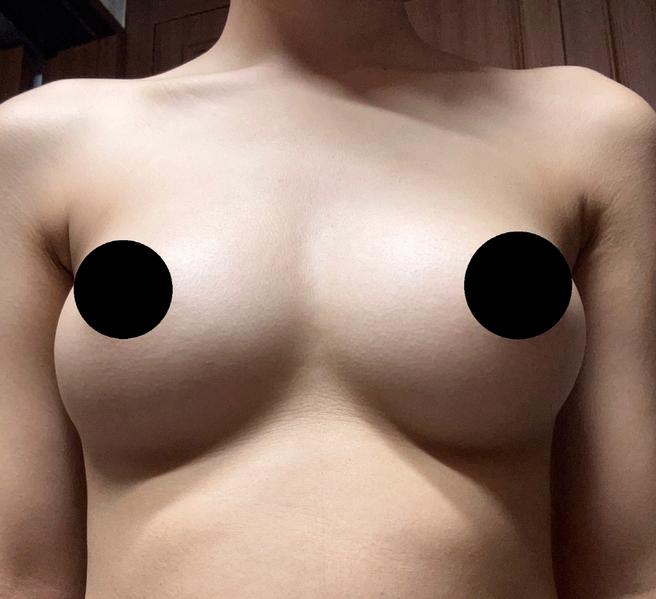 세포 가슴지방이식