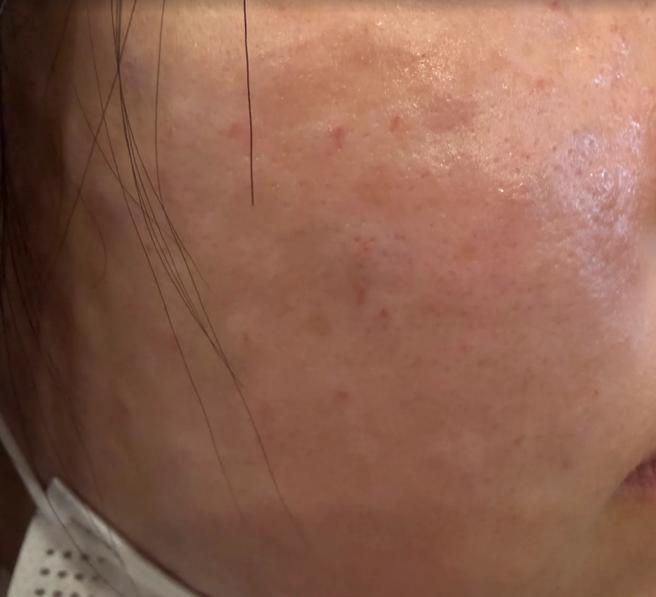 마취 덕분에 통증 없이 받았는데 엠보까지 꼼꼼하게 잘 나왔어요ㅎㅎ