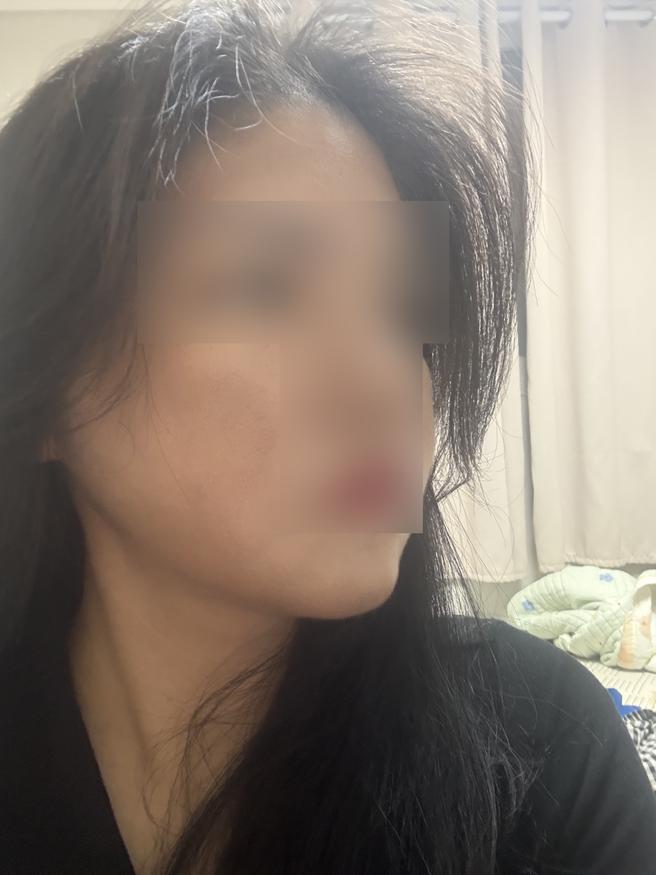 面部吸脂