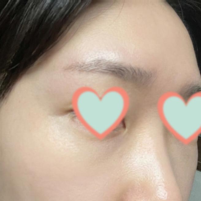 눈밑고주파 1주차, 눈밑이 확실히 환해졌어요 