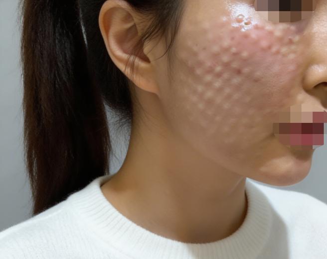 아프다고 소문난 리쥬란 처음 받았는데, 병원 직원분들이 친절하고 수면이라 편하게 받았어요~!
